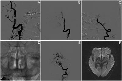 Feasibility and Safety of Paclitaxel-Coated Balloon Angioplasty for the Treatment of Intracranial Symptomatic In-Stent Restenosis